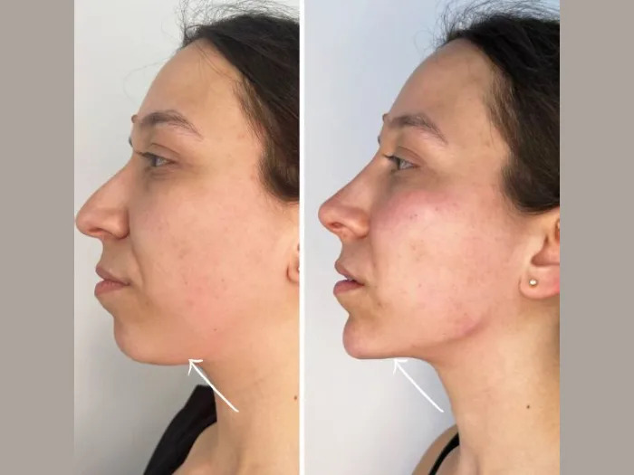 Enhance Facial Contours with Endolift at the Best Aesthetic Clinic in Dubai